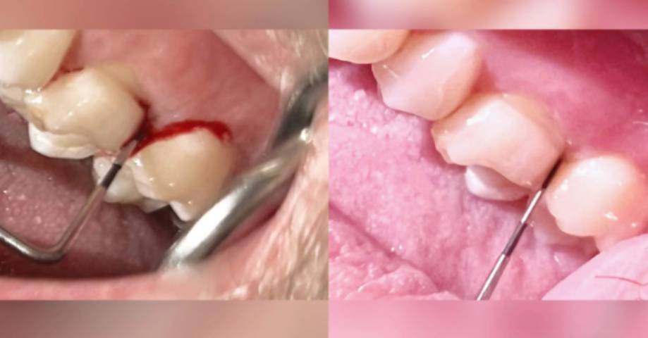 Raucher mit lokalem Attachmentverlust