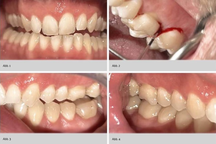 klinische Ausgangslage des vorgestellten Patientenfalls vor der Umstellung auf meridol Parodont Expert-Produkte