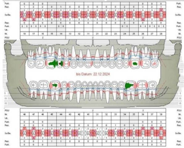 Der klinische Status vor der Umstellung auf meridol Parodont Expert-Produkte 