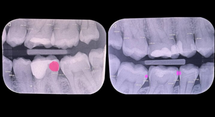 Bitewing-Aufnahmen aus dem Jahr 2024