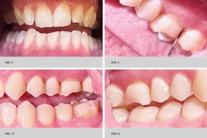 Sin pérdida significativa de inserción radiográfica.